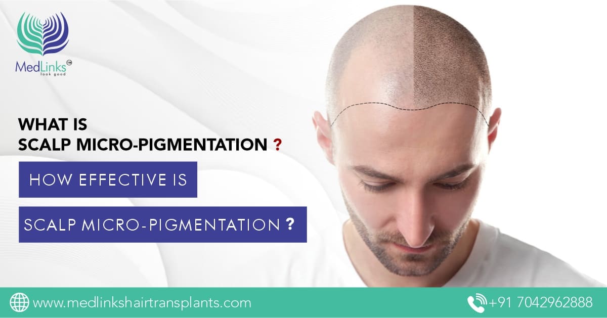 scalp micro pigmentation